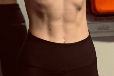 RITENZIONE IDRICA E CELLULITE